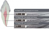 ПРОТЕЙПЕР каналорасшир. МАШИН. р-р D3 (22мм) 6шт A141022200112 DENTSPLY Швейцария 